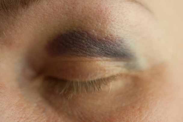 Eine Nahaufnahme auf das Auge einer schönen jungen Frau mit Blutergüssen unter dem Auge. Häusliche Gewalt Konzept mit Kopierraum  - Foto, Bild