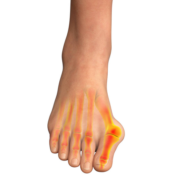 Παραμόρφωση των ποδιών, επίσης γνωστή ως hallux valgus, ή bunion, 3D εικονογράφηση - Φωτογραφία, εικόνα