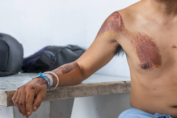 The young man's injuries to his arms and hands recovered after a motorcycle accident, causing injuries to his arms and hands before being hospitalized until his injuries and wounds improved. - Photo, Image