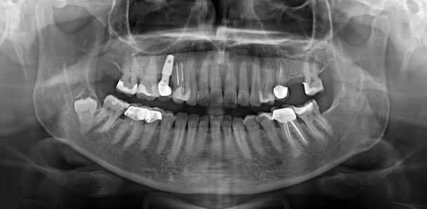 顎骨の歯、歯のインプラント、歯の充填と知恵の歯のパノラマ顎X線フィルム - 写真・画像