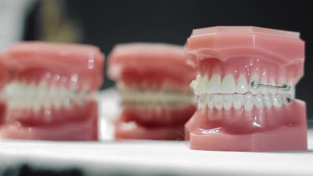 Model van de tandkloof op de plaatsing van orthodontische beugels. Varianten van plaatsing en bevestiging van orthodontisten op verschillende lay-outs. Tandheelkundige anomalie - Video