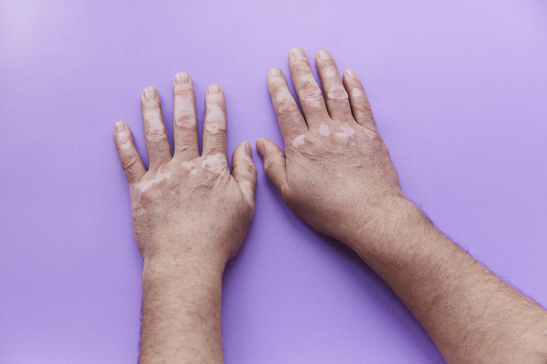 Показаны руки витилиго проблемы на фиолетовом фоне. Проблема пигментации кожи. Высокое качество фото - Фото, изображение