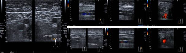 Doppler Ultrasound of Deep Vein Thrombosis Superficial Femoral Vein  compress legs Medical healthcare concept. - Photo, Image