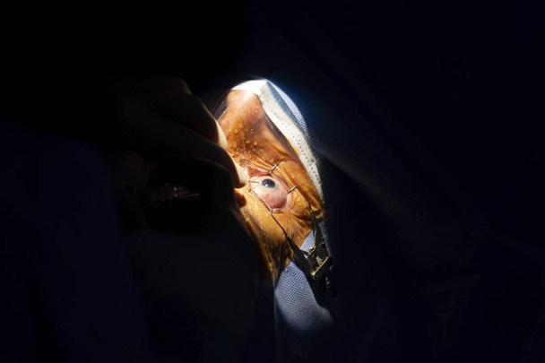 Close-up de um olho humano, cirurgia de catarata em uma sala de cirurgia oftalmologia. Cortina estéril e mãos de cirurgião com luvas estéreis inserindo ácido hialurônico na câmara anterior do olho. - Foto, Imagem