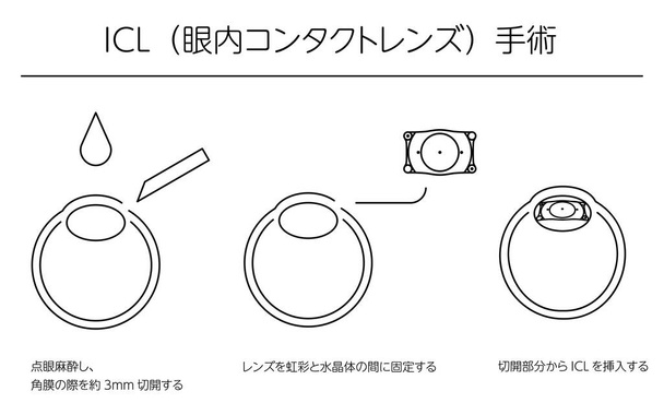 ICL (Intraocular Contact Lens) Surgery, illustrate - Vector, Image