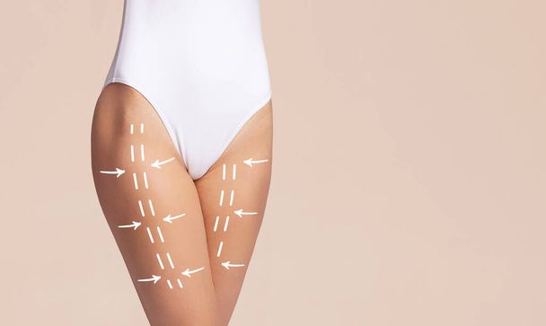 Female body with the drawing arrows on it. Fat lose, liposuction and cellulite removal. - 写真・画像