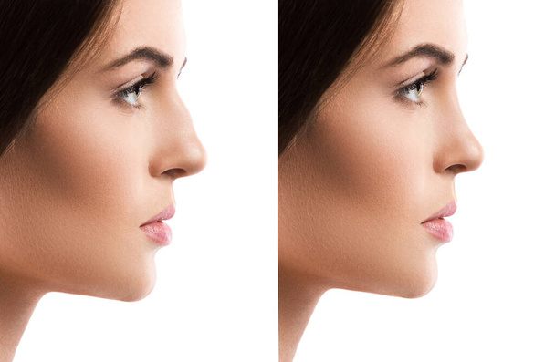 Comparison of female face after rhinoplasty on white background - Photo, Image