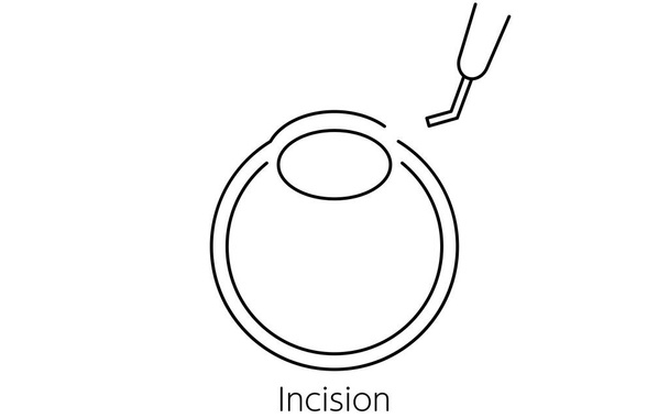 Proceso de cirugía de cataratas, Ilustración (dibujo de línea), Hacer una incisión - Vector, imagen