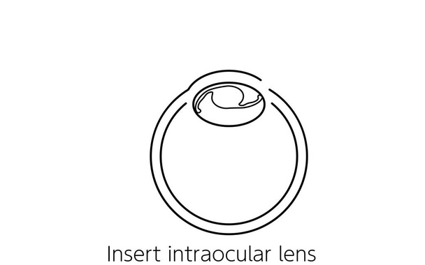 Flux de chirurgie de la cataracte, illustration (dessin au trait), insertion d'une lentille intraoculaire - Vecteur, image