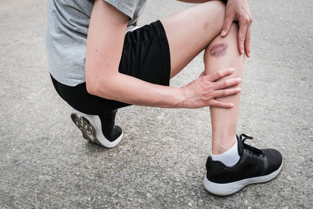 Shot of sport woman suffering from injury, she had bruise on her leg. Injured after runner falling or impact floor. Bruises happen when small blood vessels in the skin are damaged. - Photo, Image