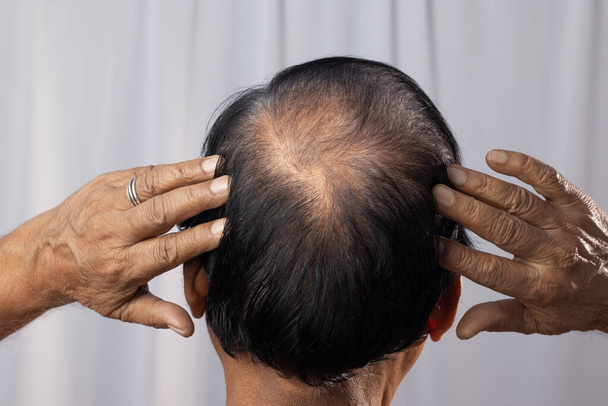 Пожилой индиец, показывающий, как его волосы отваливаются на белом фоне - Фото, изображение
