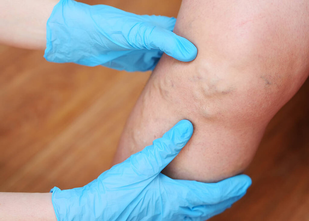 doctors hands in rubber gloves examine the varicose veins on the patients legs in close-up. - 写真・画像
