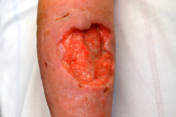 Grand ulcère trophique profond sur la jambe, défaut de la peau et des tissus mous. Complications des varices de la jambe inférieure, pleurs trophiques, eczéma, dermatite. maladie grave - Photo, image