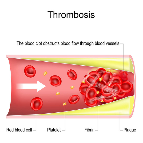 zakrzepica. Skrzep krwi utrudnia przepływ krwi przez naczynia krwionośne. Przekrój naczynia krwionośnego z płytką miażdżycową, krwinkami czerwonymi, płytkami krwi i fibryną. ilustracja wektora - Wektor, obraz