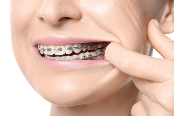 Žena se zubními rovnátky na bílém pozadí, detailní záběr - Fotografie, Obrázek