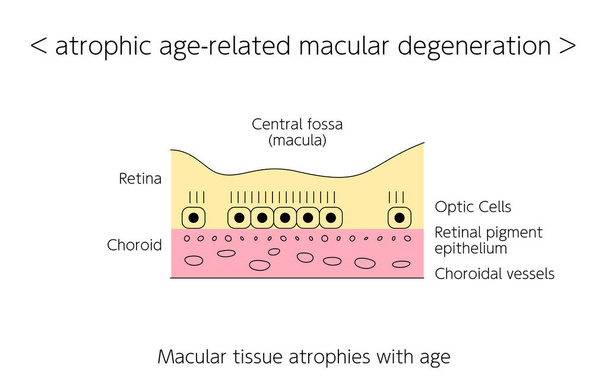 Eye Disease, Atrophic Age-gerelateerde Macula Degeneratie geïllustreerd - Vector, afbeelding