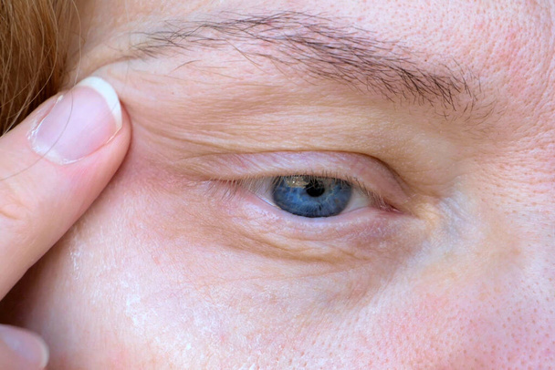 vrouwelijk oog van middelbare leeftijd met hangend ooglid. Ptosis is een hangende van het bovenste ooglid, lui oog. Cosmetologie en gezichtsconcept, vrouw met crème cosmetica vanaf de eerste rimpels, close-up - Foto, afbeelding