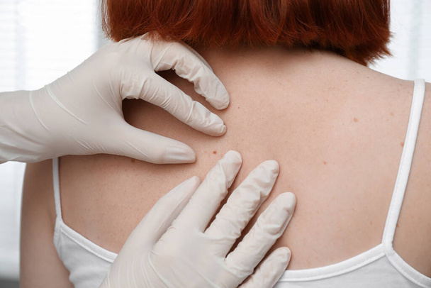 Dermatologist examining patient's birthmark in clinic, closeup view - Foto, Imagem