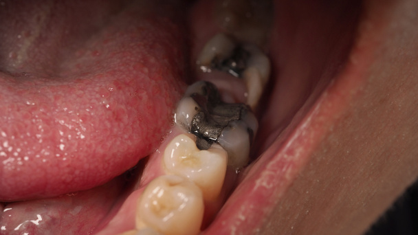 Tratamento do canal radicular dentário deteriorado. Dentes ou dentes decadência de molar inferior. Restauração com um recheio composto. Cárie adulta. Dentes maus. Material restaurador temporário dentário. Conceito dentário. de perto. - Foto, Imagem