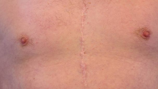 Cicatriz de una cirugía a corazón abierto en un hombre blanco, donde el esternón fue cortado en dos, y la caja torácica salió. - Foto, Imagen