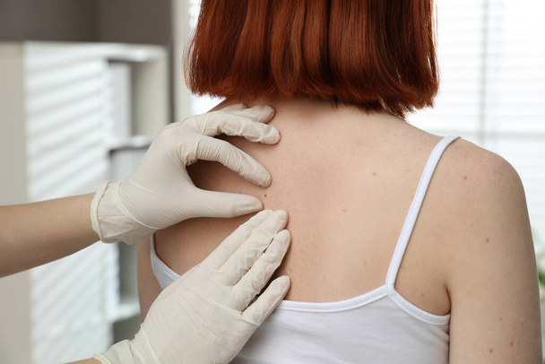Dermatologist examining patient's birthmark in clinic, closeup view - Fotoğraf, Görsel