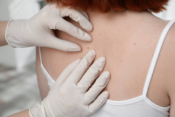 Dermatologist examining patient's birthmark in clinic, closeup view - Фото, изображение