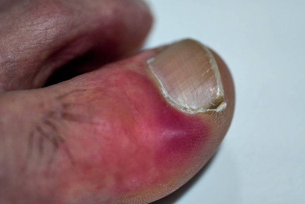 Infectie naast de nagel, in de teen van een patiënt - Foto, afbeelding