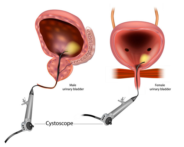 Diagrama que muestra una cistoscopia flexible para un hombre y una mujer. Anatomía Vejiga urinaria masculina y femenina. - Vector, imagen