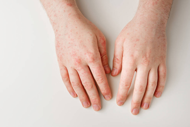Male hands on white table with red spots on skin. Allergic reaction, skin problems, dermatology. Wrong diet, side effect from taking meds - Photo, Image