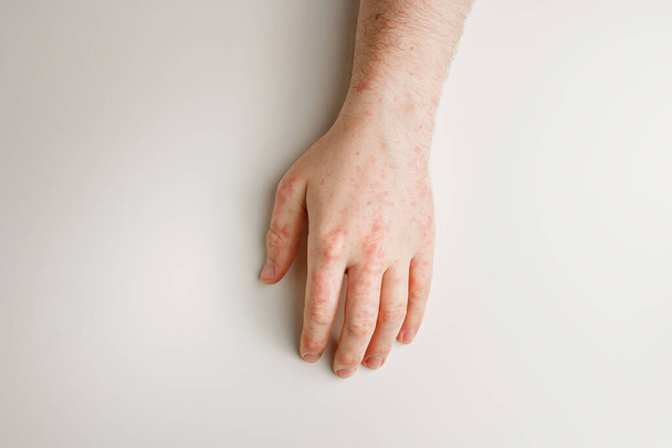 Mannelijke hand op witte tafel met rode vlekken op de huid. Allergische reactie, huidproblemen, dermatologie. Verkeerde voeding, bijwerking van het innemen van medicijnen - Foto, afbeelding