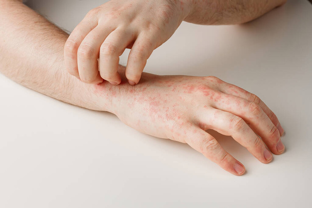Мужские руки чешут красные пятна на коже. Аллергическая реакция от неправильной диеты, побочный эффект от приема антибиотиков или лекарств. Кожные заболевания - Фото, изображение