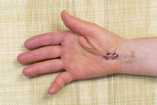 Stitches After Carpal Tunnel Surgery - Photo, Image