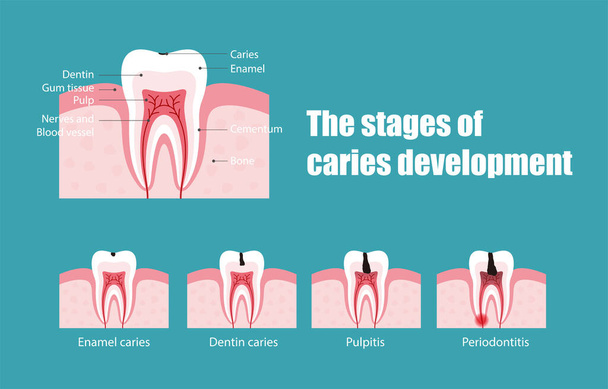 The stages of tooth decay, vector illustration - Vector, Image