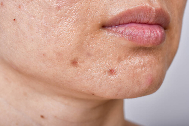Facial skin problem, Acne disease in adult, Close up woman face with whitehead pimples, Oily greasy face, Redness burnt and swelling scar after acne laser treatment. - Foto, Imagem