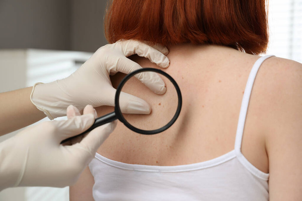 Dermatologist examining patient's birthmark with magnifying glass in clinic, closeup view - Foto, immagini