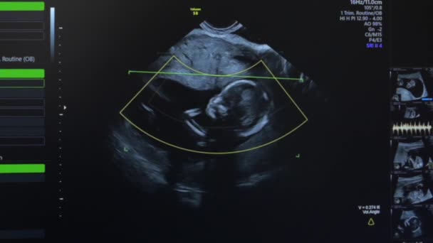 Ultrazvuk těhotné ženy - Záběry, video