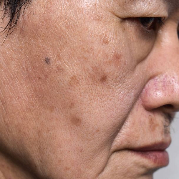 Pequeños parches marrones llamados manchas de edad en la cara del anciano asiático. También se llaman manchas hepáticas, lentigo senil o manchas solares. Vista de cerca. - Foto, Imagen