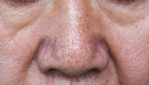 Cabezas negras o negras en la nariz del viejo asiático. Son pequeñas protuberancias que aparecen en la piel debido a los folículos pilosos obstruidos.. - Foto, Imagen