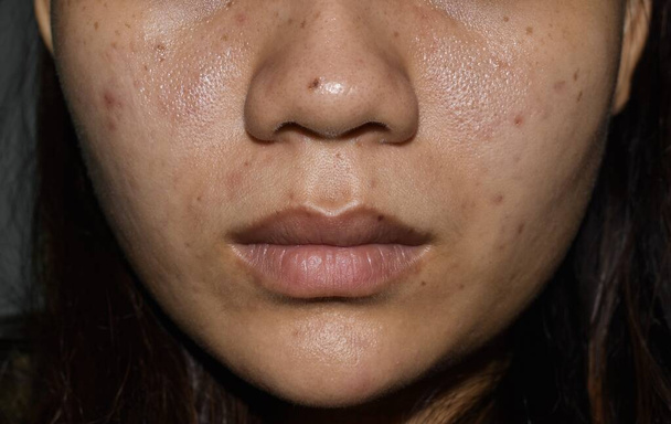 Akne, dunkle Flecken und Narben im Gesicht einer jungen Asiatin.  - Foto, Bild