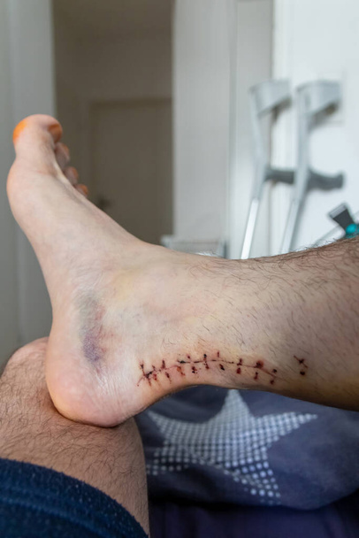 Wound suture after Achilles tendon rupture operation is treated and checked by doctor in the hospital showing stitches and operation transection with effusion of blood at European man foot - Foto, immagini