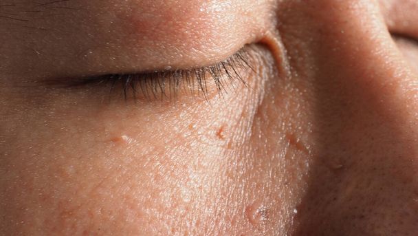 Wart skin removal. Macro shot of warts near eye on face. Papilloma on skin around eye nose and neck. Birthmark Papilla or mole on skin. small hard. benign growth on the skin caused by virus. Skincare - Photo, Image