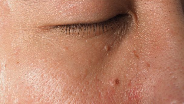 Αφαιρέστε το δέρμα από τα μαλλιά. Μακρό πλάνο μυρμηγκιών κοντά στο μάτι στο πρόσωπο. Θηλωμάτων στο δέρμα γύρω από τη μύτη και το λαιμό των ματιών. Ταυτοποίηση Παπίλα ή ελιά στο δέρμα. μικρό σκληρό. καλοήθης ανάπτυξη του δέρματος που προκαλείται από τον ιό. Περιποίηση δέρματος - Φωτογραφία, εικόνα