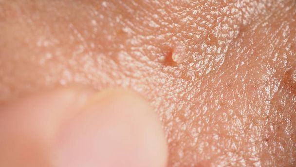 Wart skin removal. Macro shot of warts near eye on face. Papilloma on skin around eye nose and neck. Birthmark Papilla or mole on skin. small hard. benign growth on the skin caused by virus. Skincare - Foto, Imagen