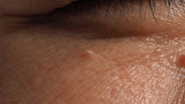 Wart skin removal. Macro shot of warts near eye on face. Papilloma on skin around eye nose and neck. Birthmark Papilla or mole on skin. small hard. benign growth on the skin caused by virus. Skincare - Photo, Image