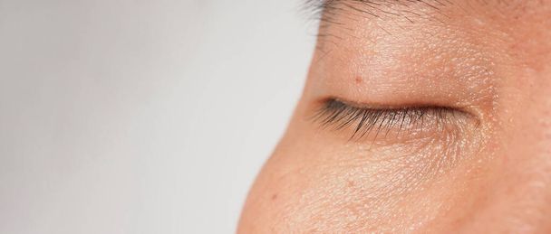 Syylä ihon poisto. Makro laukaus syyliä lähellä silmää kasvoihin. Papillooma iholla silmän nenän ja kaulan ympärillä. Syntymämerkki Papilla tai luomi iholla. Pieni kova. viruksen aiheuttama hyvänlaatuinen kasvu iholla. Ihonhoito - Valokuva, kuva