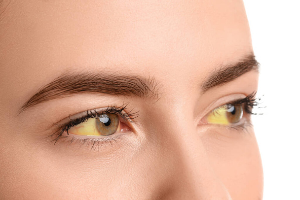 Young woman with yellow eyes on white background, closeup. Hepatitis symptom - Foto, Imagen