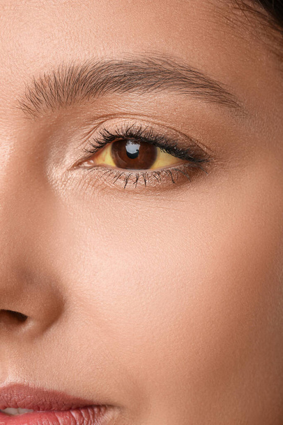 Young woman with yellow eyes, closeup. Hepatitis symptom - Photo, Image