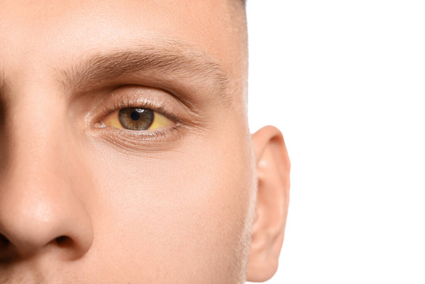 Junger Mann mit gelben Augen auf weißem Hintergrund, Nahaufnahme. Symptom Hepatitis - Foto, Bild