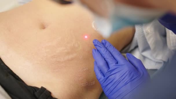 Lazer cilt tedavisi gören bir kadın ya da cilt bakımı kliniğindeki yara izlerinin lazeri. Yüzündeki kırışıklıklar, yaralar ve güneş hasarları için yüzey tekniği. - Video, Çekim