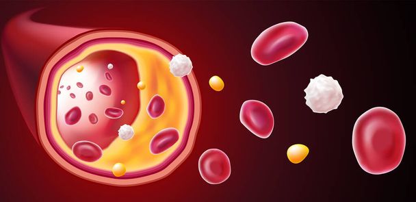 3D-Illustration von roten Blutkörperchen, weißen Blutkörperchen und Cholesterin, die die Todesursache verstopfen. - Vektor, Bild